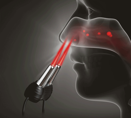 Апарат для лазерної терапії риніту Zdeer Laser Diode Therapy Device (ZD-BY10N)